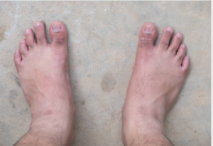 Signs and Symptoms of Diabetic Foot Ulcer