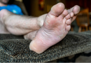 Signs and Symptoms of Diabetic Foot Ulcer