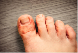 Signs and Symptoms of Diabetic Foot Ulcer