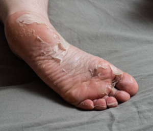 Signs and Symptoms of Diabetic Foot Ulcer