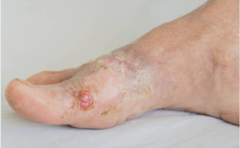 Signs and Symptoms of Diabetic Foot Ulcer